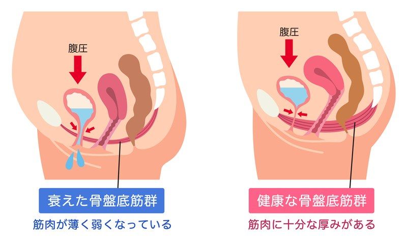 骨盤底筋群の衰えと健康な状態の比較イラスト。左側の衰えた骨盤底筋群(筋肉が薄く弱く尿もれが生じる状態)と、右側の健康な骨盤底筋群(十分な厚みがあり尿道をしっかり締める状態)における腹圧と臓器のメカニズムを図解