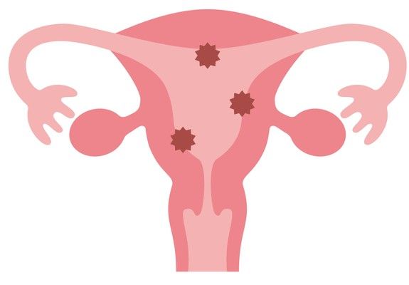 子宮体がんの発生部位を示すイラスト。子宮の上部(体部・子宮内膜)に発生するがん(悪性腫瘍)の病変部を表した医学図解