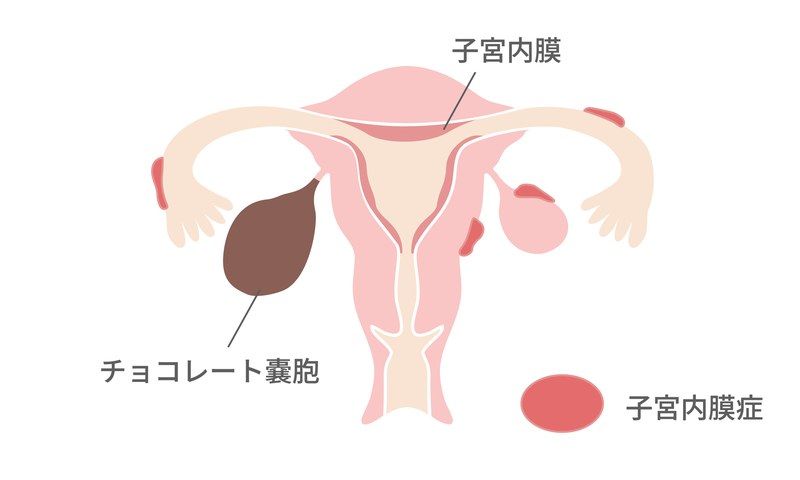 子宮内膜症とチョコレート嚢胞の発生メカニズムを示す医療イラスト。正常な子宮内膜以外の場所(卵巣や卵管など)に発生する子宮内膜症病変と、卵巣内に古い血液が溜まるチョコレート嚢胞の位置を図解