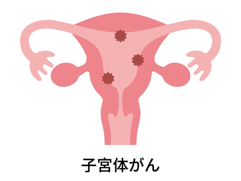 子宮体がんの発生部位を示すイラスト。子宮の上部(体部・子宮内膜)に発生するがん(悪性腫瘍)の病変部を表した医学図解